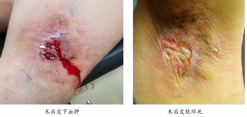 大汗腺清除术
