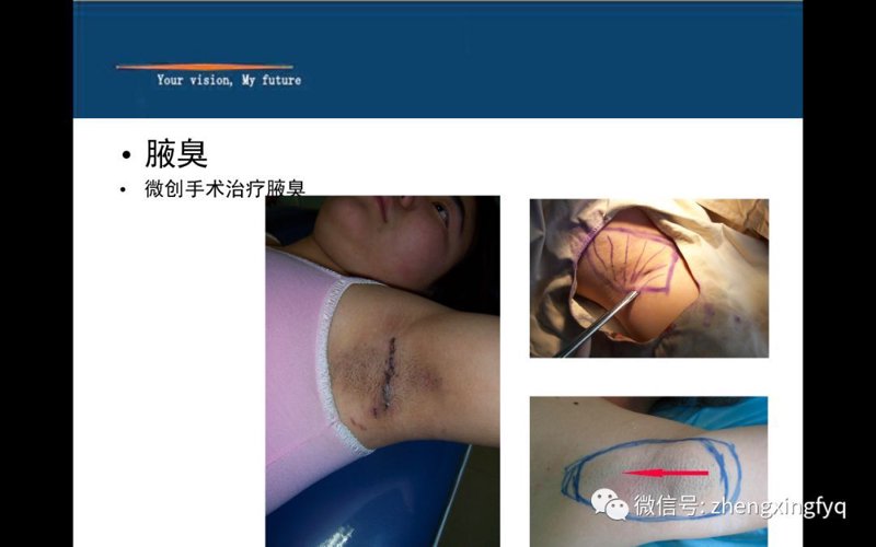 腋臭(腋窝多汗症)的手术、肉毒素及微波治疗